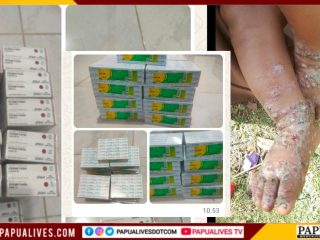 Dengar Keluhan 8 Kampung di Mewoluk, Dinkes Papua Tengah Gerak Cepat Kirim Salep Permetrin